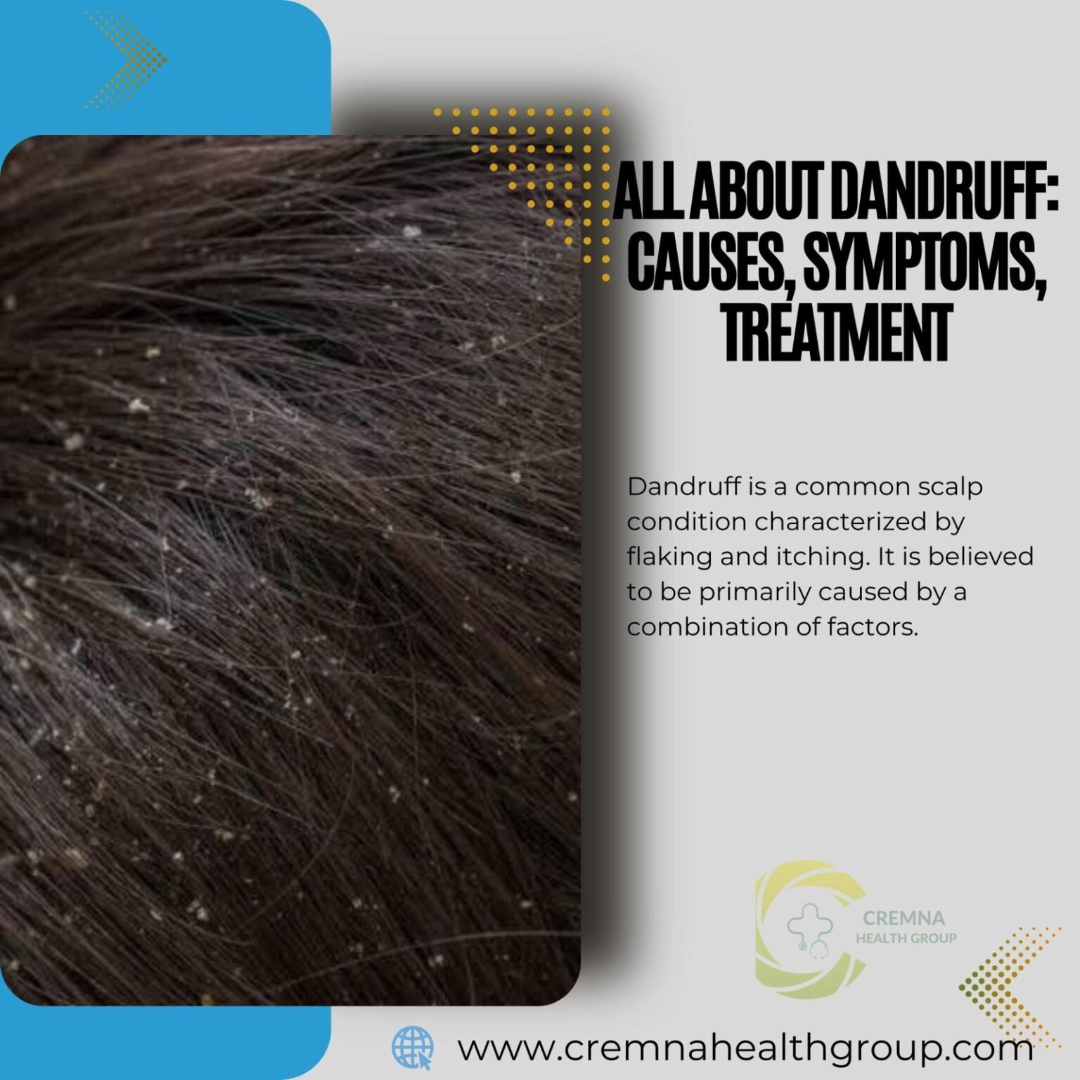 All About Dandruff Causes Symptoms Treatment Cremna Health Group 7264